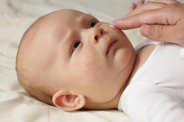 宝宝长湿疹是不是因为孕期没排胎毒?其实没有胎毒这一说-有孕帮